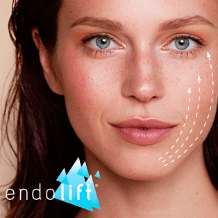 tratamiento-endolift-madrid