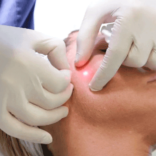 tratamiento-endolift-tensado-madrid